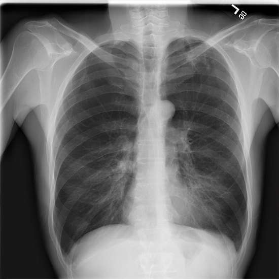 Chest X-Ray lateral Decubitus view, Preparation, Procedure, and the Requirements